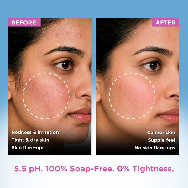 [Combo Pack] Anti Acne Soap + Sensitive Skin Syndet Bar - Pack of 4 + 4