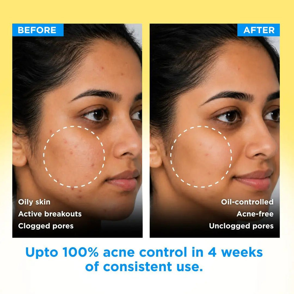 Anti Acne Soap - Pack of 8