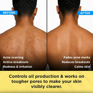 Anti Acne Soap - Pack of 8