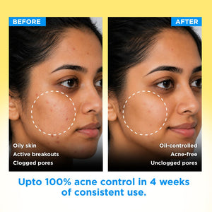 Anti Acne Soap - Pack of 8