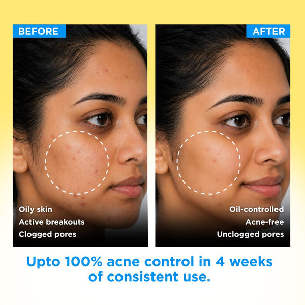 Anti Acne Soap - Pack of 8