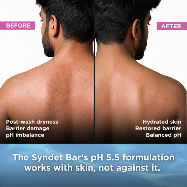 Sensitive Skin Syndet Bar - Pack of 4