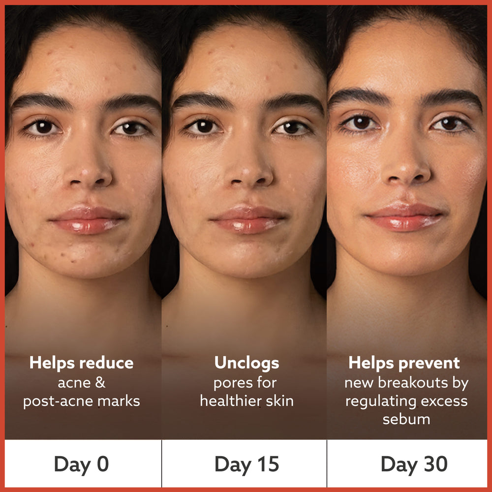 Anti Acne Soap - Pack of 4