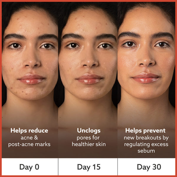 Anti Acne Soap - Pack of 4