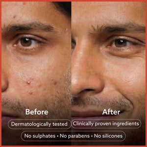 Anti Acne Soap - Pack of 4