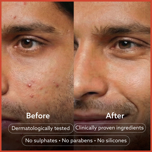 Anti Acne Soap - Pack of 4