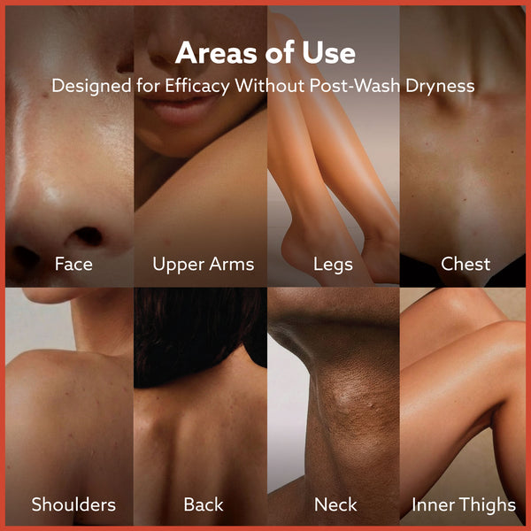 Anti Acne Soap - Pack of 4