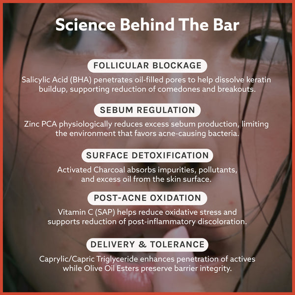 Anti Acne Soap - Pack of 4