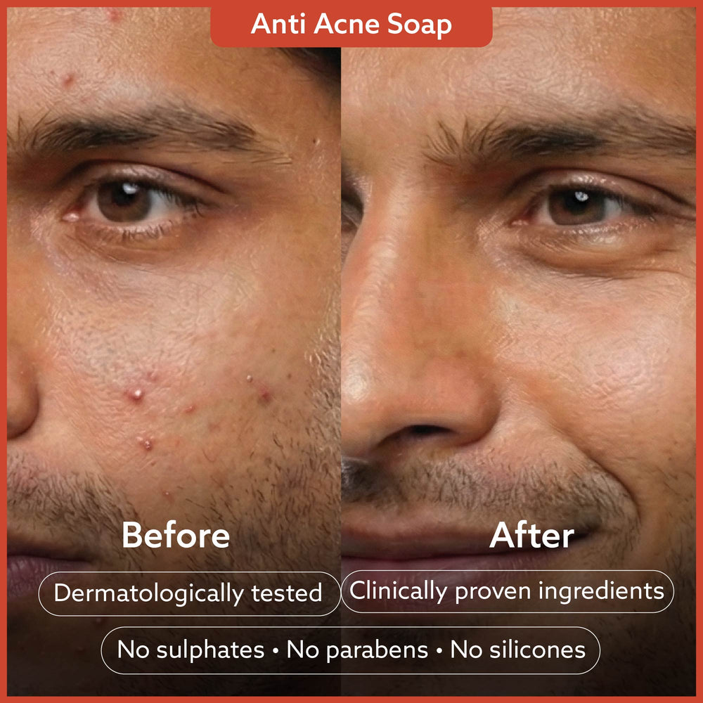 [Combo Pack] Anti Acne Soap + Sensitive Skin Sydnet Bar - Pack of 4 + 4